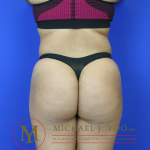 Brazilian Butt Lift Before & After Patient #1263