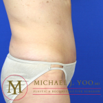 Tummy Tuck Before & After Patient #1319