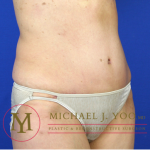 Tummy Tuck Before & After Patient #1319