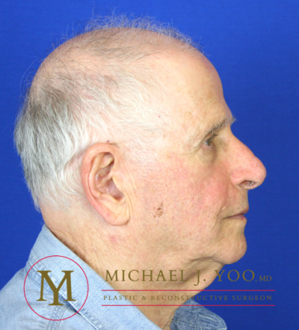 Mohs Surgery Before & After Patient #1279