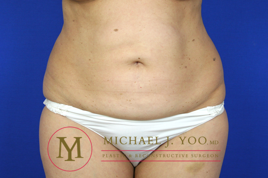 Tummy Tuck Before & After Patient #1319