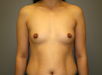 Breast Augmentation Before & After Patient #1268
