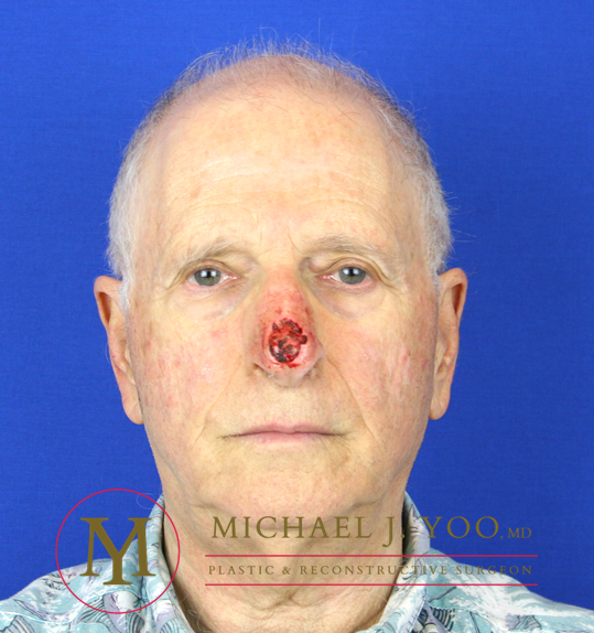 Mohs Surgery Before & After Patient #1279