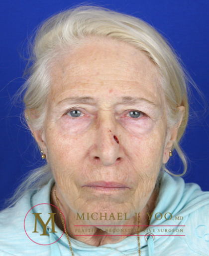 Mohs Surgery Before & After Patient #1291