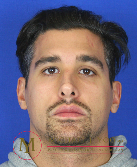 Rhinoplasty Before & After Patient #1308