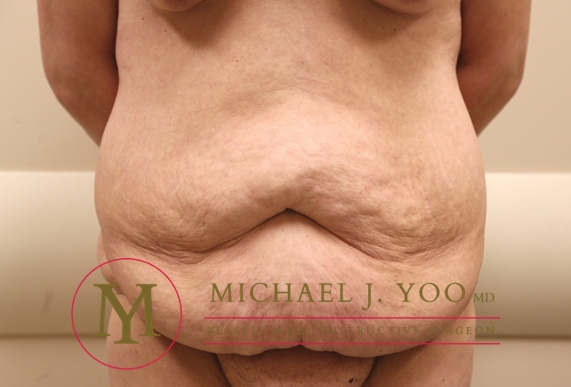 Tummy Tuck Before & After Patient #1257