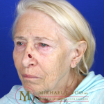 Mohs Surgery Before & After Patient #1291