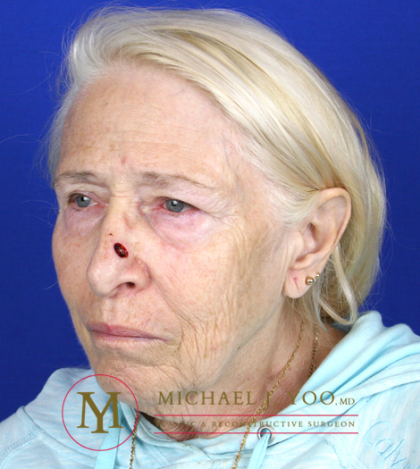 Mohs Surgery Before & After Patient #1291