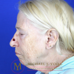 Mohs Surgery Before & After Patient #1291