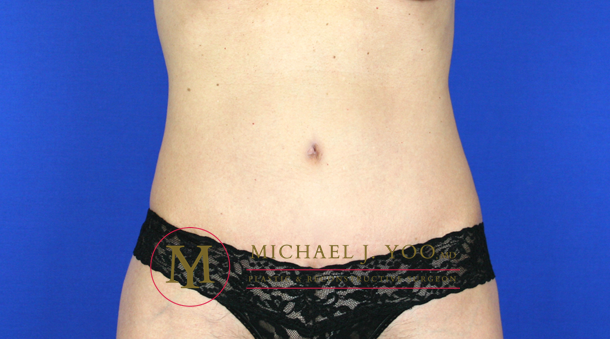 Tummy Tuck Before & After Patient #1554