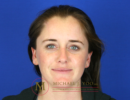 Mohs Surgery Before & After Patient #1573