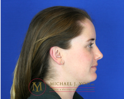 Mohs Surgery Before & After Patient #1573