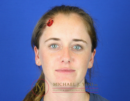 Mohs Surgery Before & After Patient #1573