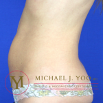 Tummy Tuck Before & After Patient #1554