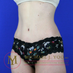 Tummy Tuck Before & After Patient #1923