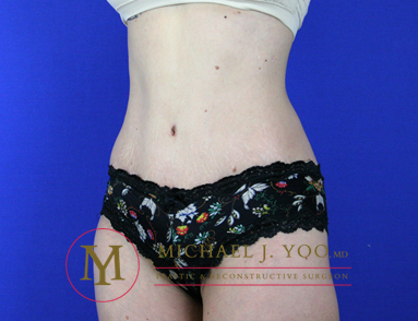 Tummy Tuck Before & After Patient #1923