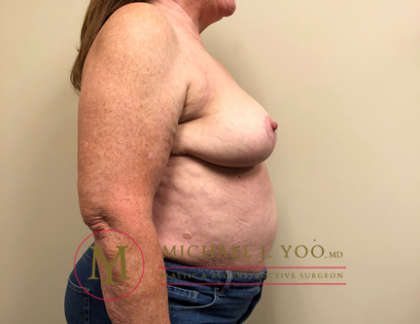Breast Reduction Before & After Patient #1909