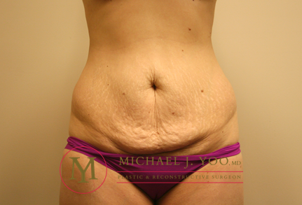 Tummy Tuck Before & After Patient #1923