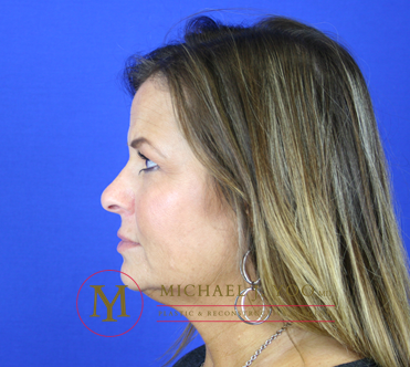 Rhinoplasty Before & After Patient #1916