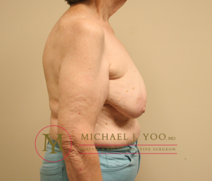 Oncoplastic Breast Reconstruction Before & After Patient #1902