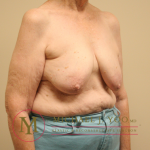 Oncoplastic Breast Reconstruction Before & After Patient #1902