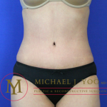 Tummy Tuck Before & After Patient #2022