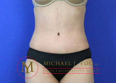 Tummy Tuck Before & After Patient #2022