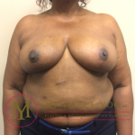 Breast Reduction Before & After Patient #2015