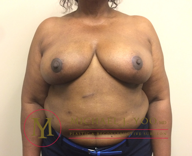 Breast Reduction Before & After Patient #2015