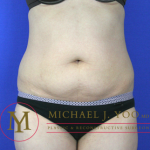 Tummy Tuck Before & After Patient #2022
