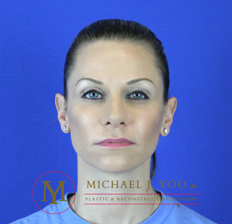 Rhinoplasty Before & After Patient #2069