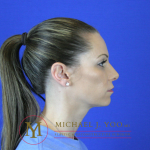 Rhinoplasty Before & After Patient #2069