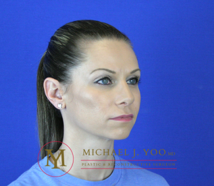 Rhinoplasty Before & After Patient #2069
