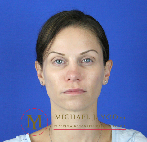 Rhinoplasty Before & After Patient #2069