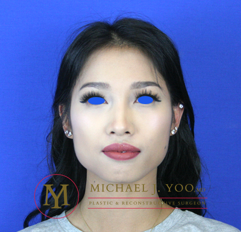 Fillers Before & After Patient #2141