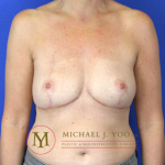 Oncoplastic Breast Reconstruction Before & After Patient #2148