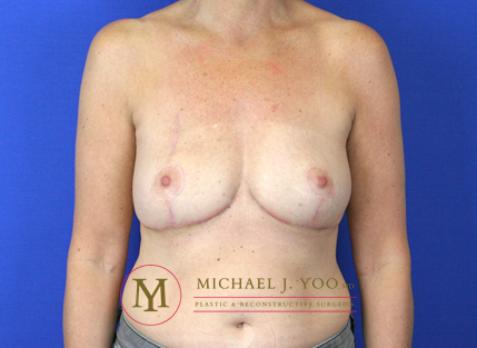 Oncoplastic Breast Reconstruction Before & After Patient #2148