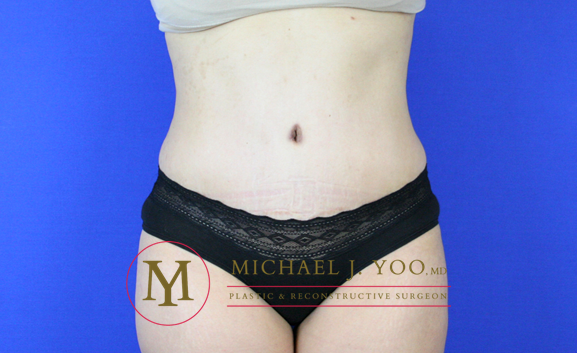 Tummy Tuck Before & After Patient #2155