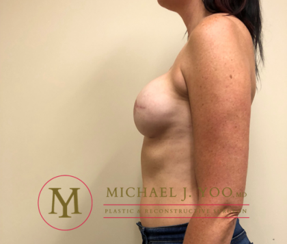 Mastectomy Breast Reconstruction Before & After Patient #2134