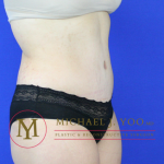 Tummy Tuck Before & After Patient #2155
