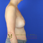 Oncoplastic Breast Reconstruction Before & After Patient #2148