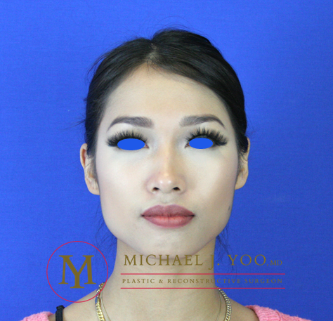 Fillers Before & After Patient #2141