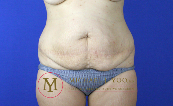 Tummy Tuck Before & After Patient #2155
