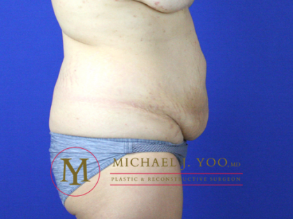 Tummy Tuck Before & After Patient #2155