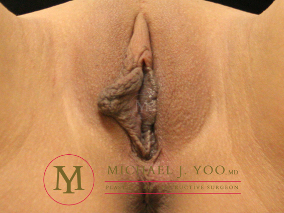 Body Before & After Patient #2214