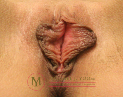 Labiaplasty Before & After Patient #2192