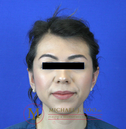 Otoplasty Before & After Patient #2258