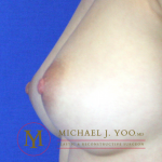 Nipple Reduction Before & After Patient #2268