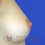 Nipple Reduction Before & After Patient #2268