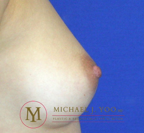 Nipple Reduction Before & After Patient #2268